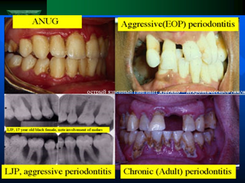 острый язвенный гингивит язвенно – некротического гингивита Венсана